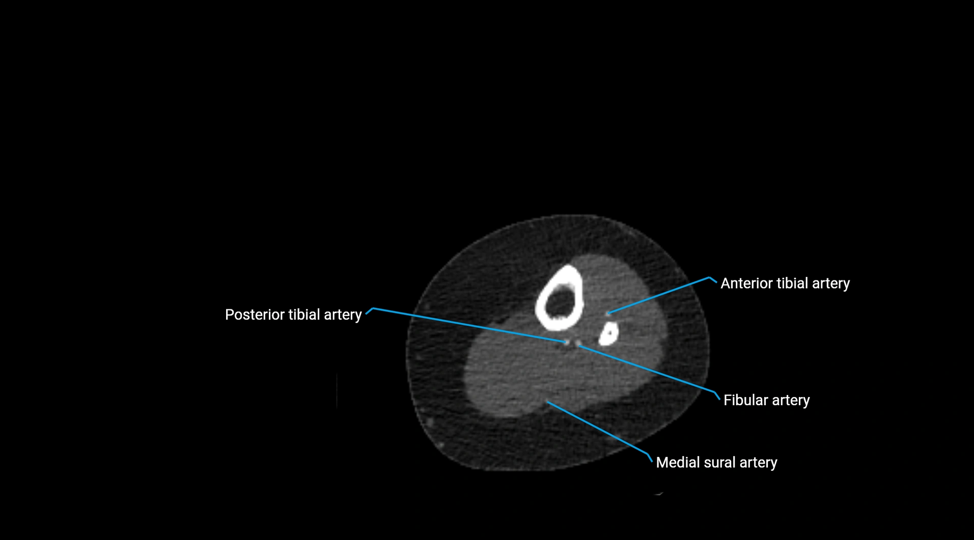 CTA lower limb cross sectional anatomy labelled image _204.webp